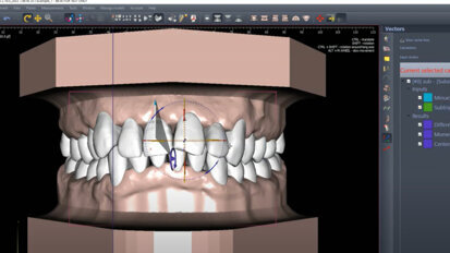 Polorto – DDP-Ortho – 3D Biomechanics Planner by Giorgio Fiorelli