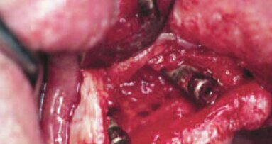 Cechy systemu implantów stomatologicznych i ich potencjalny wpływ na uzyskanie i utrzymanie efektu estetycznego