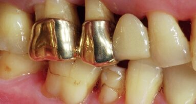 Open-healing approach to avoid flap mobilization and subsequent morbidity