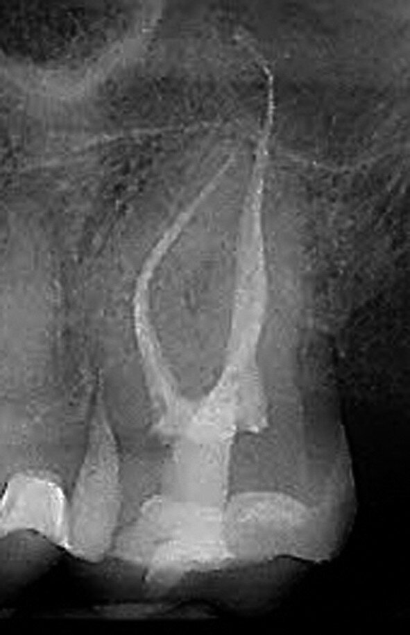 Fig. 6 : Cette radiographie postopératoire montre un très petit orifice d’accès cavitaire. Les cornes pulpaires latérales mésiale et distale ont été laissées intactes pendant le traitement canalaire et obturées au cours de la phase de restauration postendodontique. Cet aspect est une source de fierté au sein du club IBAC. (Photo : fournie par le Dr Jeff Pafford) 