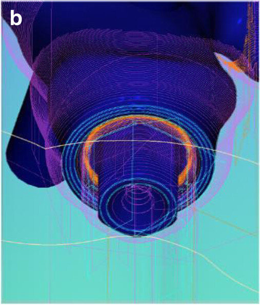 Fig. 12b: Occlusal view showing CAD of the final FDP (a) and detailed screenshot of the interface geometry (b).