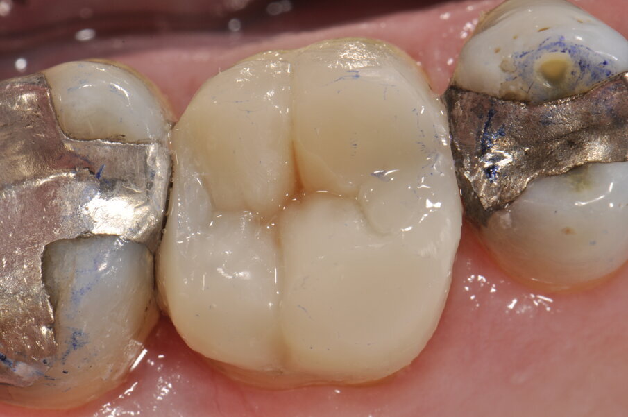 Fig. 11: Ajustes oclusales.