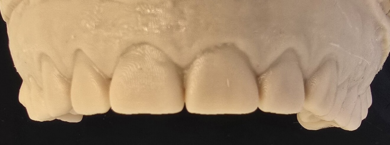 Fig. 2b: Diagnostic wax-up showing improved tooth proportions.