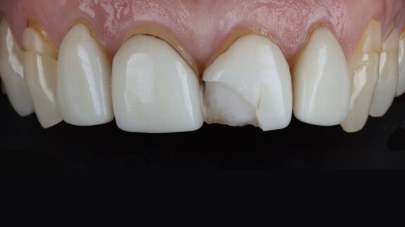 Glass-ceramic veneer cementation: Full adhesive workflow with PANAVIA Veneer LC