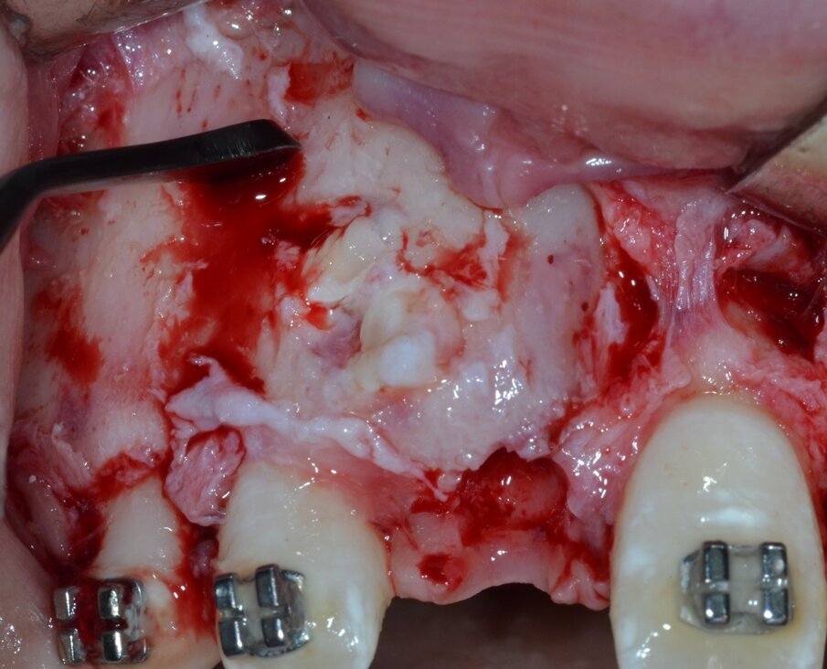 Fig. 6_Ostectomia per erosione della corticale ossea.