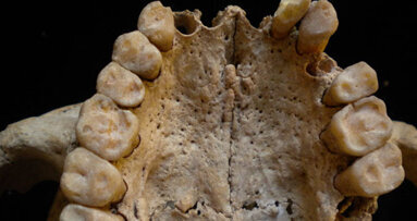 Grave paraodontopatia con reazione ossea paradontale associata a deficit vitaminico in stati carenziali