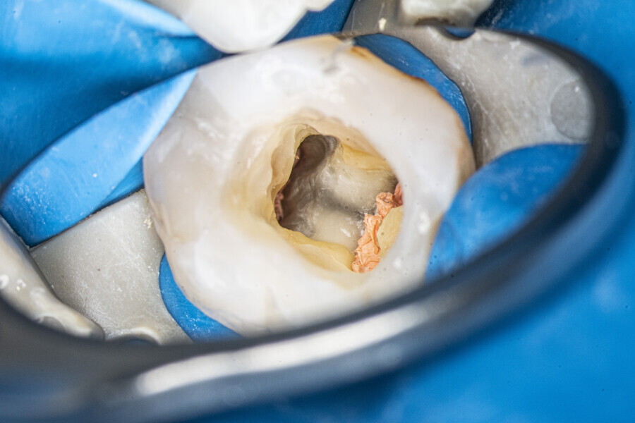 Fig. 33: The pulp chamber with filled canals.