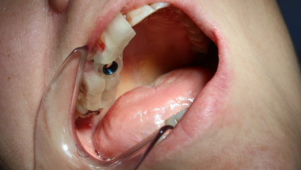 Implantacja natychmiastowa z szablonem drukowanym 3D