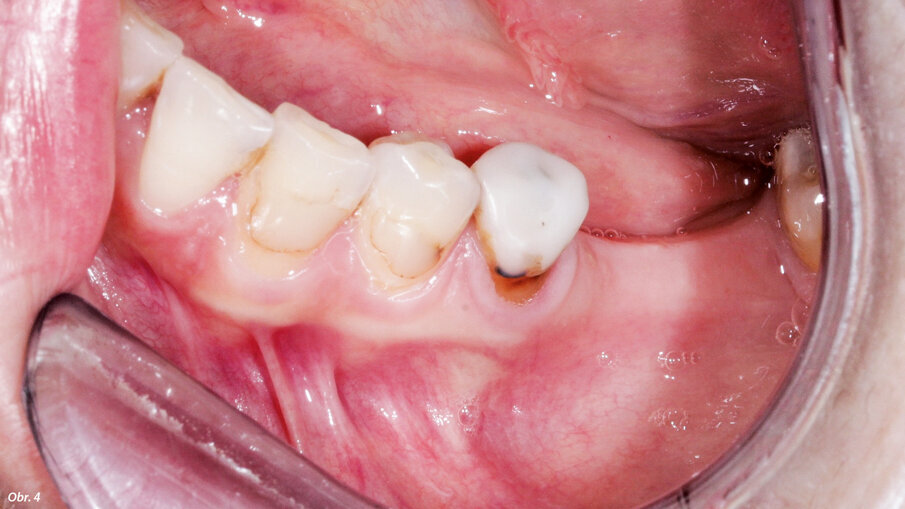 Vážné riziko dehiscence.