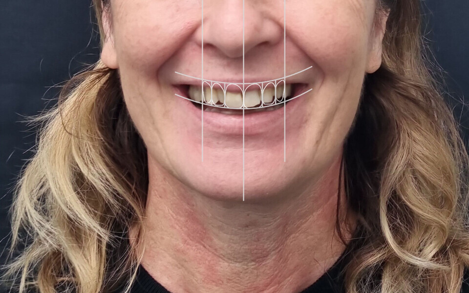 Fig. 4: Facial lines when assessing the initial situation. The deviation of the midline was accepted.