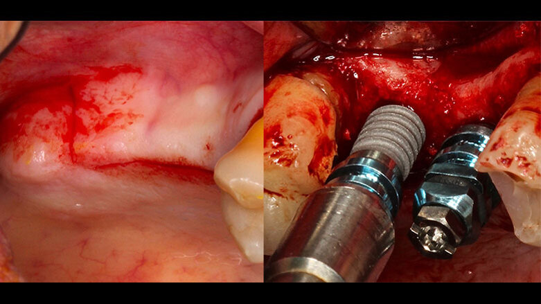Cirugía implantológica avanzada
