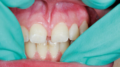 Léčba diastematu v horní čelisti: Úvod a povaha problematiky