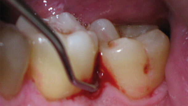 La terapia parodontale non chirurgica mediante laser: studio microbiologico