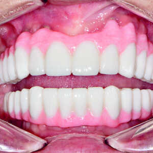 Fig-21-Vue-des-dents-non-engrenées-300x300-