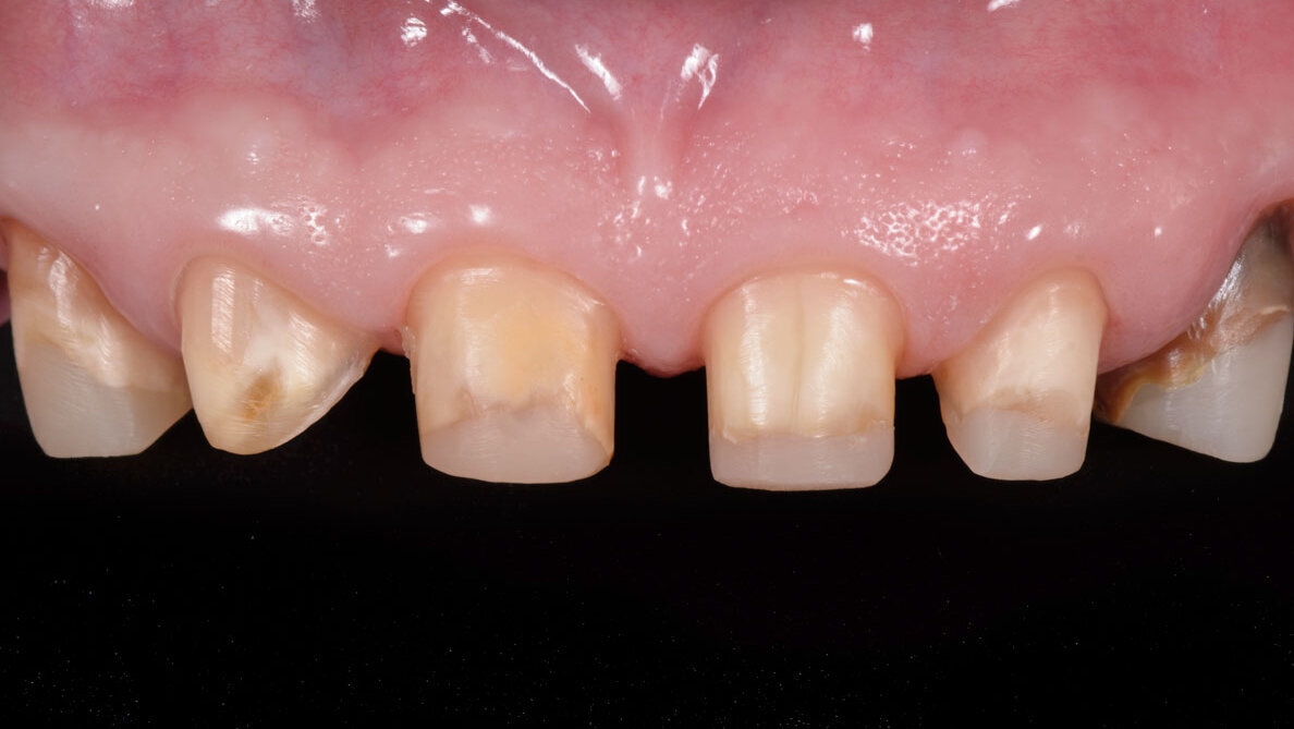 Erupción forzada en ortodoncia