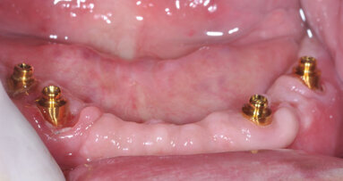 Upper and lower dentures on Rhein83 components