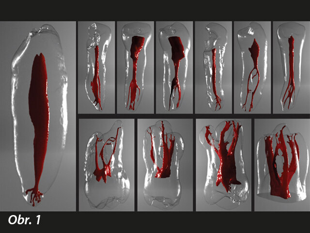 Komplexnost systémů kořenových kanálků ukazuje na oblasti, které nemohou být dosaženy mechanickou preparací