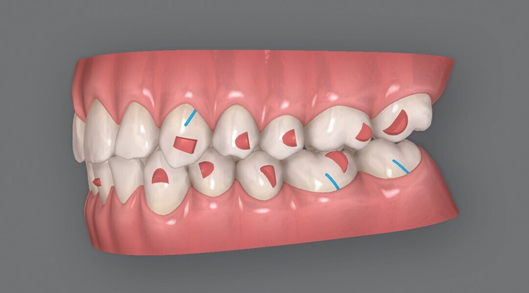 Fig. 4e : Premier résultat prévu par simulation ClinCheck.