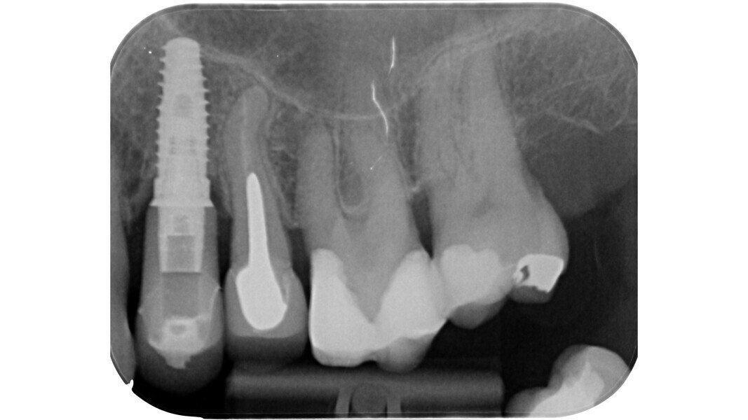 Fig. 27: Pre-op radiograph of a maxillary molar. Note the evident contraction of the pulp chamber and the root canal system.