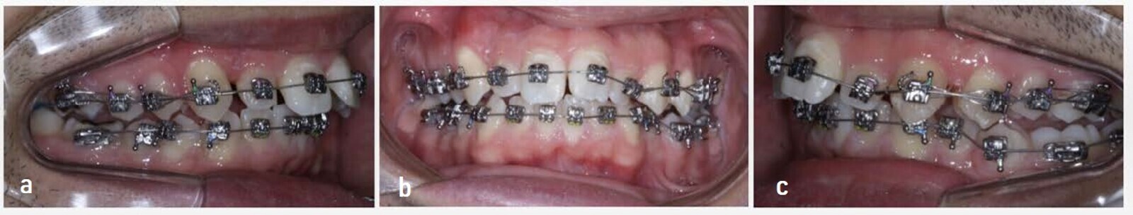 Figs. 13a–c: Carriere SLX Brackets System in both arches and 0.014 in. copper NiTi archwire. 