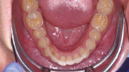 Ricostruzioni funzionali  nei settori posteriori con un nuovo composito altamente biocompatibile