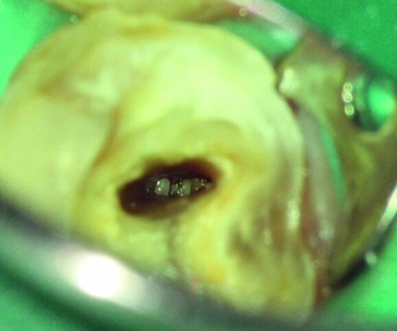 Fig. 5: Inspection of a prepared oval shaped distal canal of a lower molar reveals residual debris apically. 