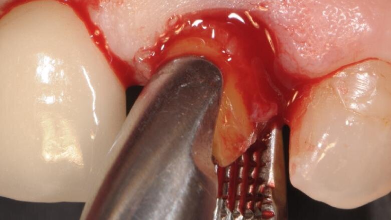 Impianto in zirconia post-estrattivo immediate