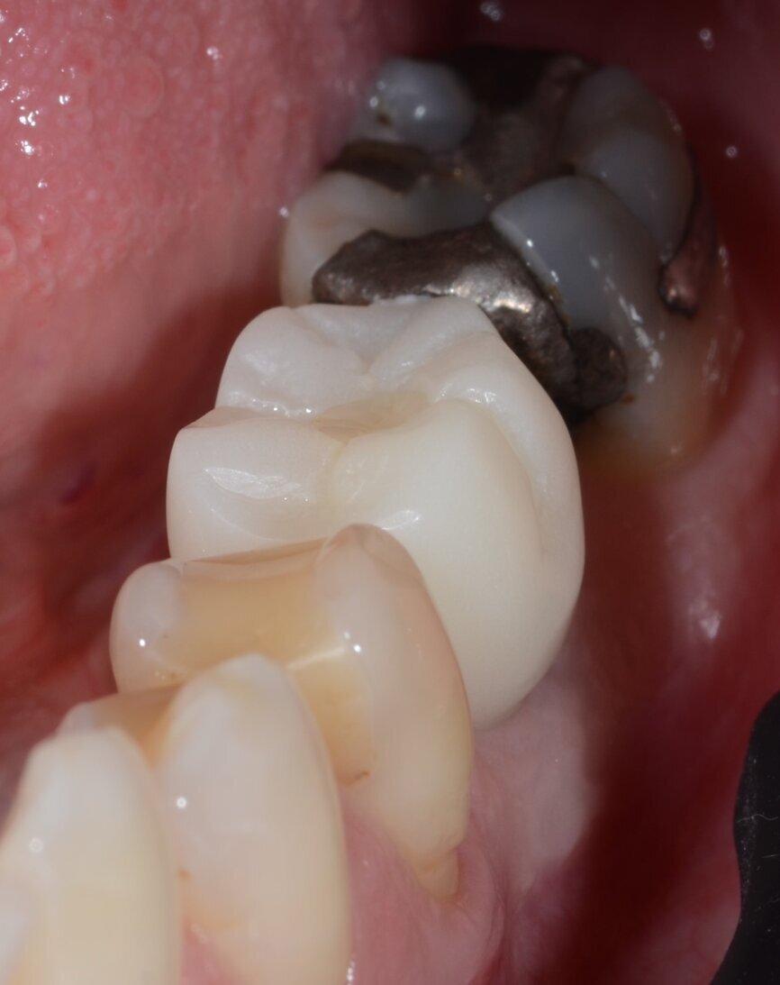 Fig. 14: Temporary crown in position with the screw access channel closed, lateral view.