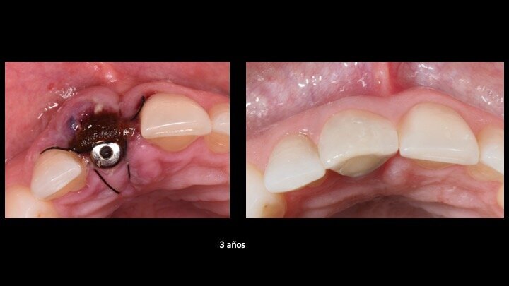 Figuras 21 y 22. Imágenes del día de la intervención y a los 3 años de evolución. Se observa una regeneración casi completa del periodonto, a pesar de presentar un defecto óseo inicial muy importante en la tabla ósea cortical vestibular. Con esta técnica solucionamos en un solo acto quirúrgico, tanto la preservación como la regeneración ósea, con gran estabilidad de los resultados en el tiempo.