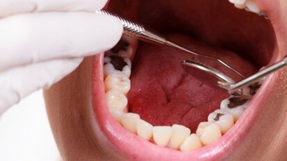 Płaskie plomby psują zgryz!