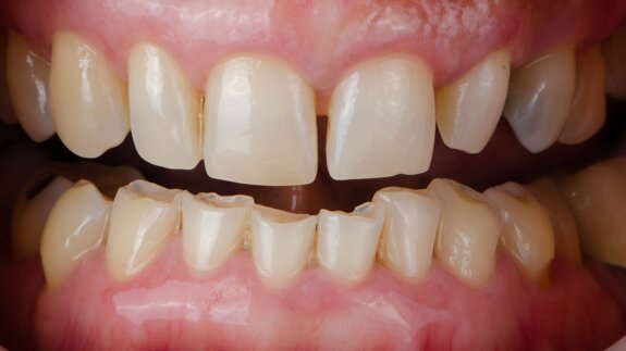 Early diagnosis is key: GC Dental Campus webinar to discuss direct restorations for tooth wear