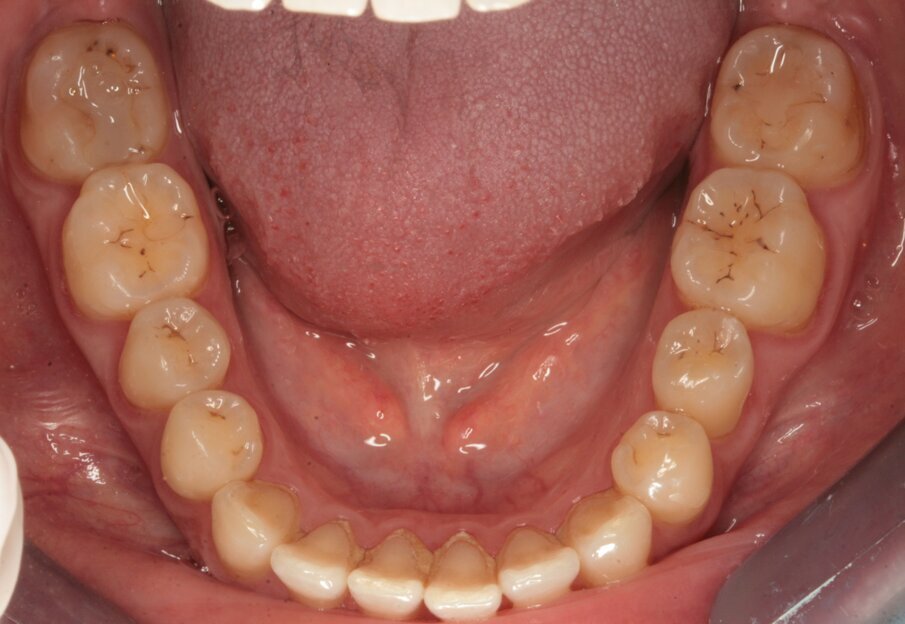 Fig. 2_Visione occlusale dell’arcata inferiore.