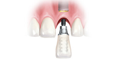 Okamžité zatížení: Co znamená pro pacienta a zubní ordinaci?