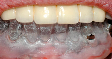 Protesi avvitata a medio lungo termine a carico immediato. Tecnica del “porta impronte dinamico”