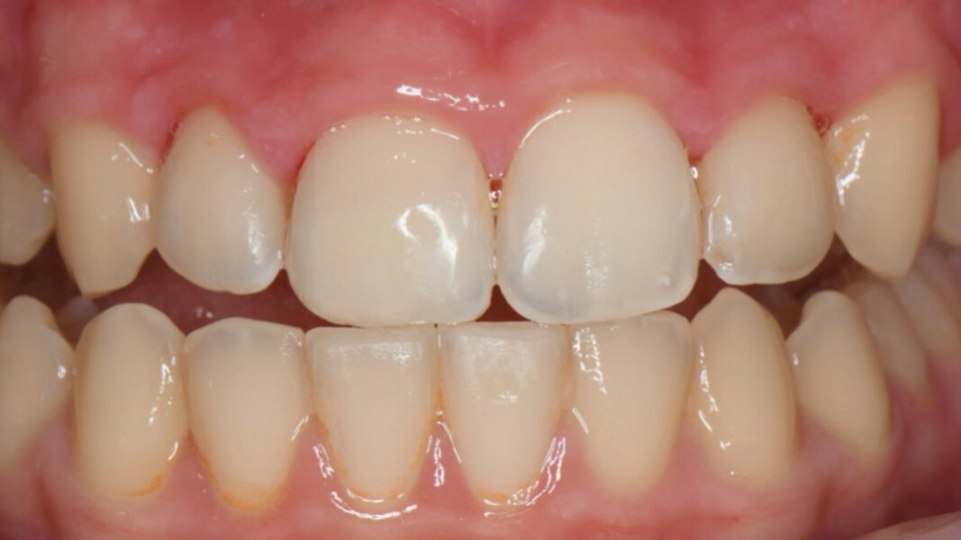 Figg. 7, 8 - Risultato finale del sorriso post-trattamento.