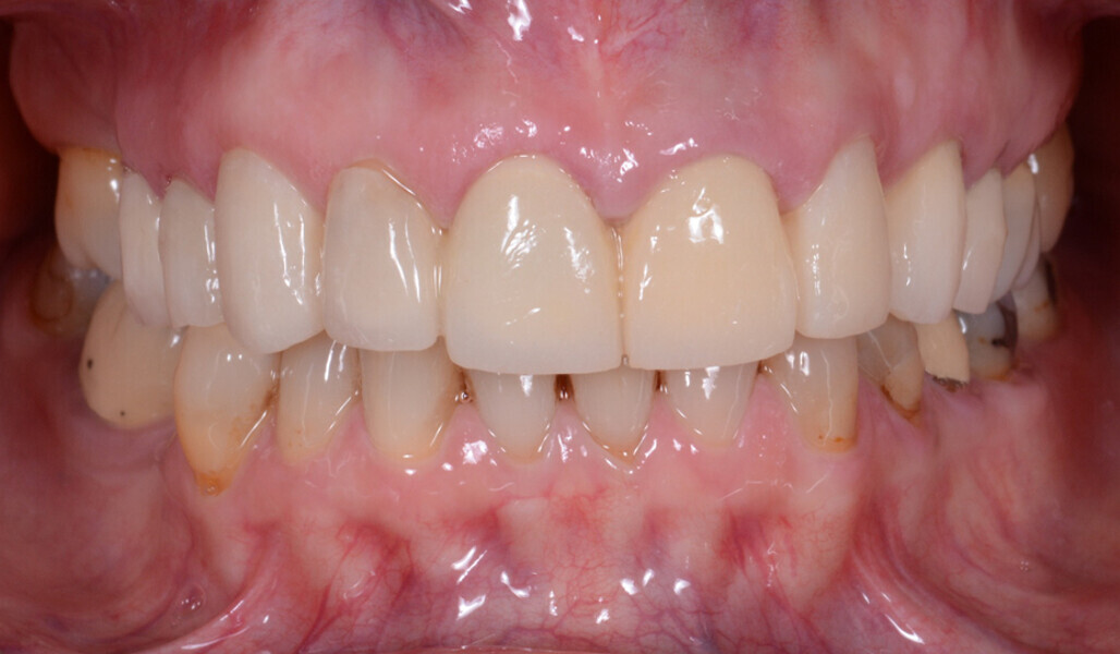 Fig. 9: Temporary restoration in place.