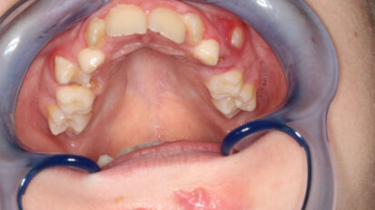 “Praatjes vullen geen gaatjes, maar voorkomen gaatjes”