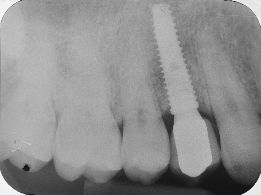 Fig. 26 - Esame radiografico endorale di controllo.