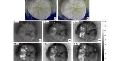 Nieuwe beeldvormende techniek kan vroege cariësdetectie bevorderen