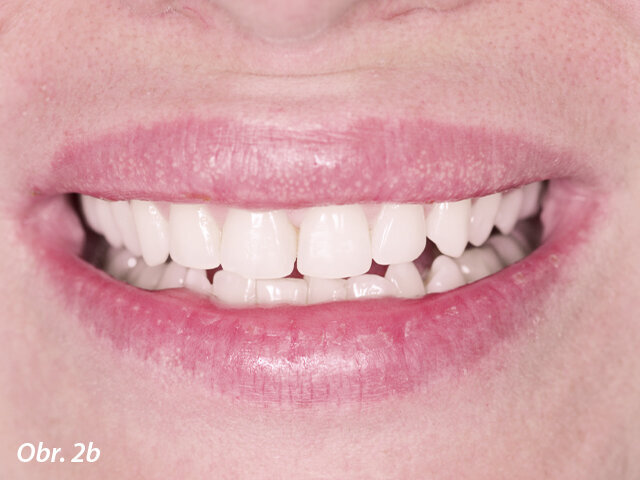 Cílem tohoto estetického ošetření bylo vylepšit úsměv pacientky. Při úpravě nebo korekci smile designu je však vedle všech základních estetických parametrů rovněž důležité zohlednit analýzu obličeje a osobnost pacientky, a to proto, aby bylo možno při současné minimální invazivitě vytvořit co nejpřirozenější personalizovaný smile design.