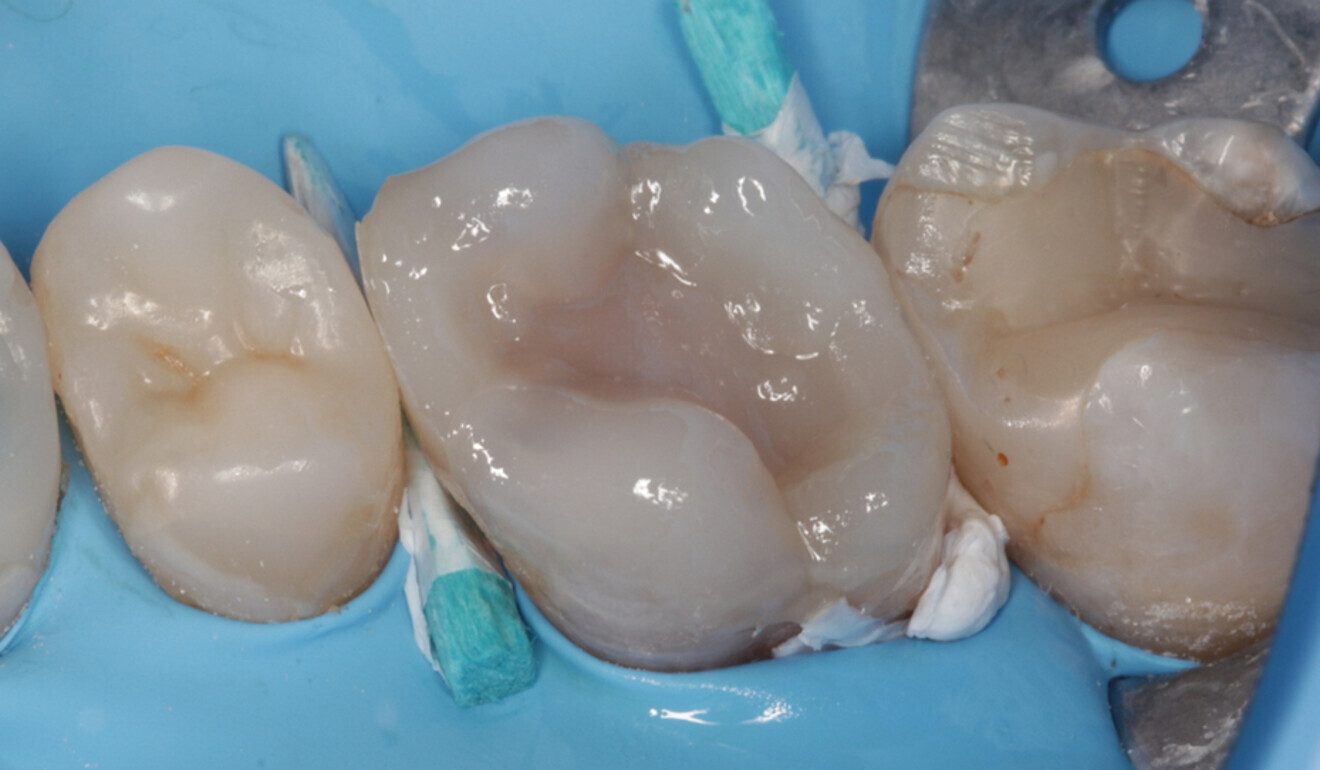 Fig. 14: Core build-up, palatal view. Freehand cusp coverage with CLEARFIL MAJESTY ES-2 Universal. (Image: Kuraray Noritake Dental)