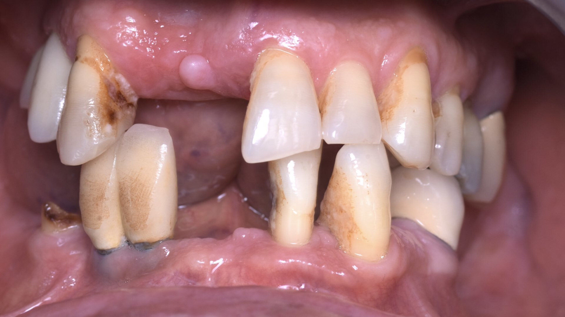 Huit implants pour un sourire