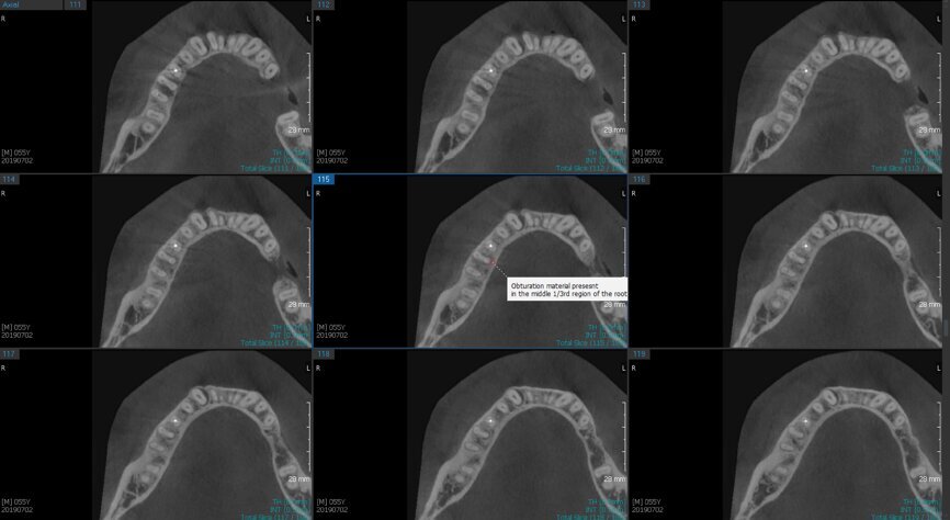 Fig.2d: Pre-op CBCT images of tooth #46: No obturation material in the distal and mesiobuccal canal (a); scanty obturation of the canals and breach of the floor of the pulp chamber, no obturation beyond a few millimetres down the orifice (b & c); radiolucency in the furcation area and periapical region of both roots (d -g).