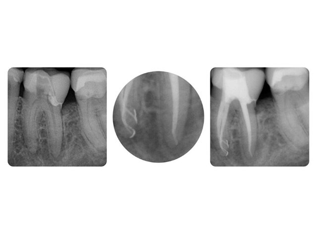 Příklad ošetření dolního moláru. Zde byl systém kanálků po úspěšném opracování dostatečně vypláchnut v celém rozsahu pomocí roztoků EDTA a NaOCl. Následně byly otevřeny i postranní kanálky a rozpuštěny zbytky tkání v nich obsažené. Dobře provedený výplach je proto po vhodném termoplastickém zaplnění kanálků patrný i na rentgenovém snímku a slouží zároveň jako kritérium kvality. Průběh kořenové výplně je jasně ohraničen a postranní kanálky jsou rovněž zaplněny.