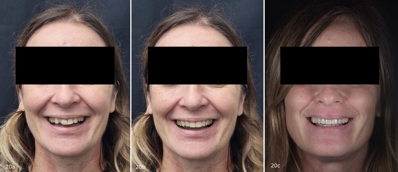 Figs. 20a–c: (a) Extra-oral photographs of the initial situation, (b) after Invisalign Smile Architect simulation and (c) of the final result obtained.