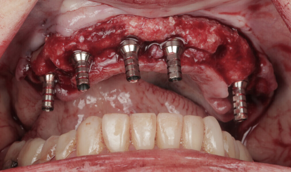 Fig. 12: Temporary abutments attached to the multi-unit abutments.