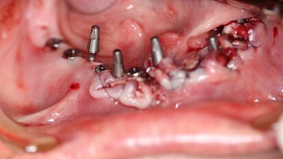 Implantacja z wykorzystaniem szablonu nawigacyjnego 3D – opis przypadku