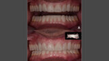 Fig. 6. a Mock-up motivacional. b Mock-up motivacional y escaneo intraoral.