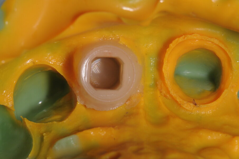 Fig. 12 - Visione dell’impronta eseguita in silicone.