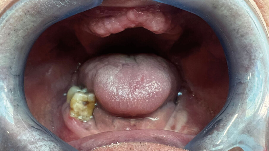 Fig. 8 - Mucosa gengivale prima della scopertura delle viti tappo e successivo inserimento dei monconi.